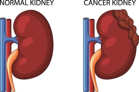 Embolisasi Pembuluh Darah Sebagai Persiapan Pembedahan Pada Tumor