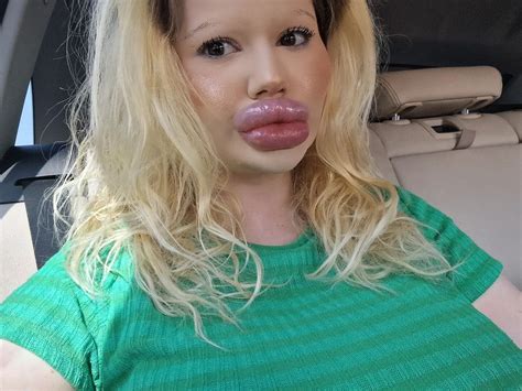 Жінка з найбільшими губами у світі тепер хоче переплюнути українку 