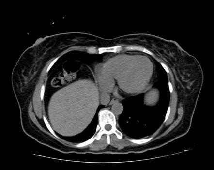 Colonic Interposition Radiology Case Radiopaedia Org