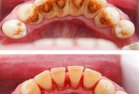 Scaling Root Planing Before And Stains