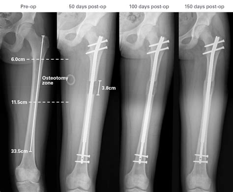 Intramedullary Nail Tibia Fracture Cpt Code Bios Pics