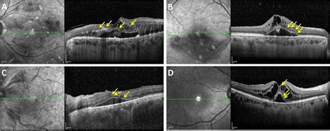 The Representative Sd Oct Images Of Macular Edema Showing Hrf In