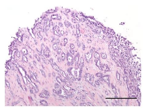 A Prostate Gland Prostatic Adenocarcinoma Note The Neoplastic Cells Download Scientific