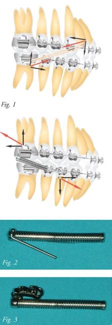 Correcting Class Ii Malocclusions With The Forsus Appliance Dr Lisa Alvetro Orthotown