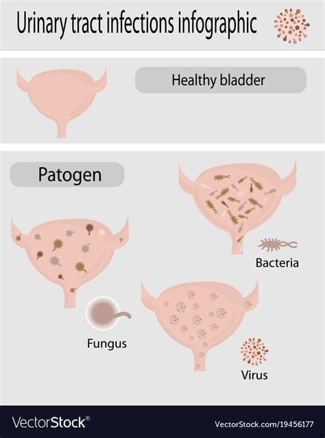 Urinary Tract Infection Infographic Royalty Free Vector