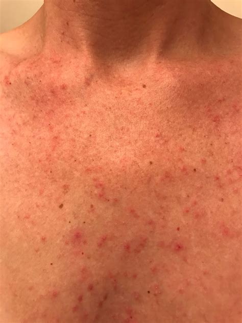 Skin Cancer Itchy Rash