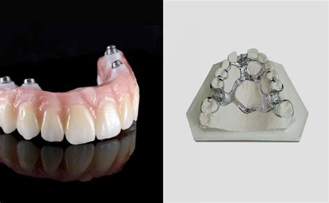 Flippers/Dentures vs Dental Implants: What are the Differences?