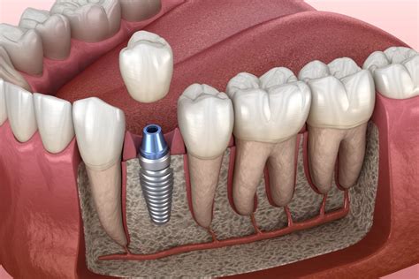 Implantate Zahnarzt Pfingstnerat