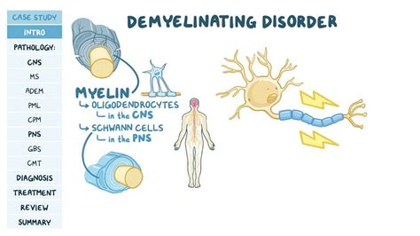 Demyelination And Demyelinating Disease 45 OFF