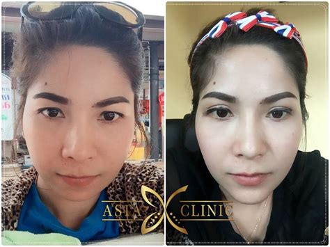 Double Eyelid Surgery Before And After Photos