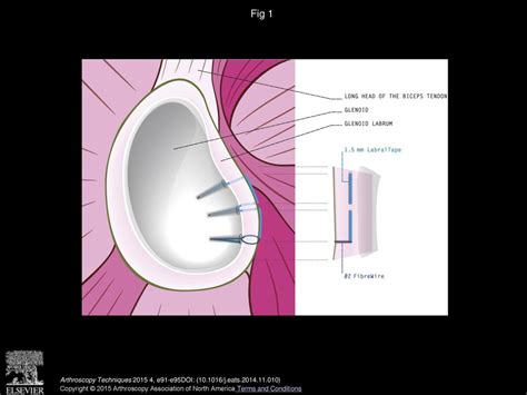 The Labral Bridge A Novel Technique For Arthroscopic Anatomic