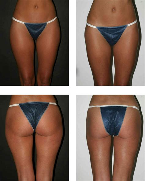 Quick And Easy Or Painful And Risky The Truth About Liposuction