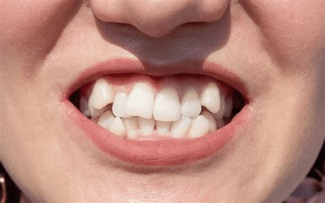 Ways To Straighten Your Teeth Without Braces Excel Dental