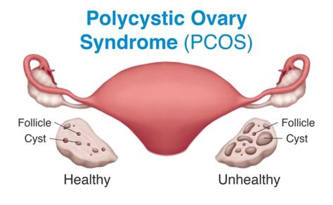 What Is Poly Cystic Ovary Syndrome Pcos And Its Causes My Gynae