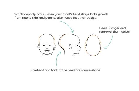 Scaphocephaly Treatment & Info | ROKband Headshape Clinics