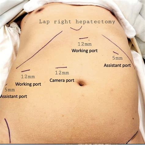 Laparoscopic Ports Placement In Laparoscopic Major Liver Resection