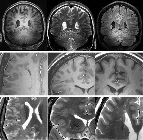 Structural Association Between Heterotopia And Cortical Lesions