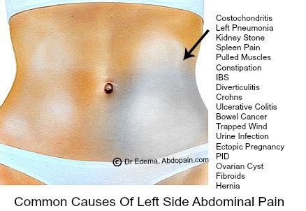 Left Side Abdominal Pain: Causes, Diagnosis & Treatment | ABDOPAIN.com