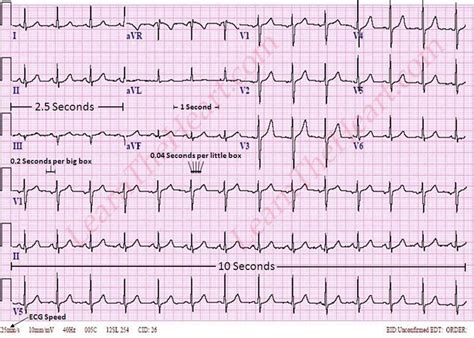 Approach To Ecg Interpretation How To Interpret A 12 Lead Ecg