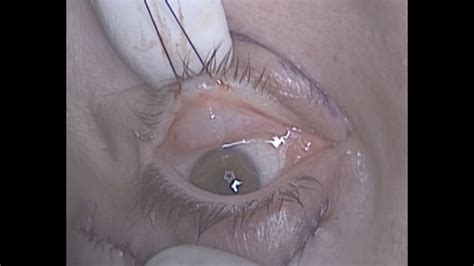 Transconjunctival Lower Lid Blepharoplasty With Fat Transposition Prof