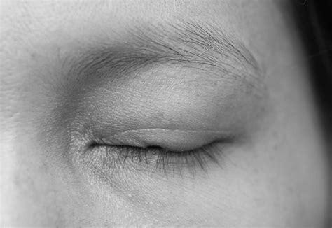 Eyelid Tumor Reconstruction | Eagle & Boise, ID — Aesthetic Eye, P.C.