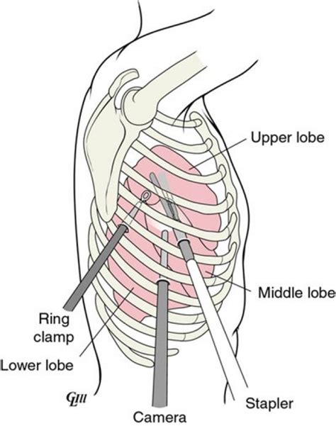 Video Assisted Thoracic Surgery Department Of Cardiothoracic Surgery