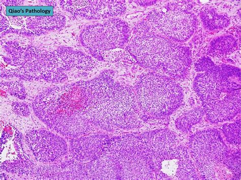 Flickriver Photoset Basaloid Squamous Cell Lung Carcinoma By Qiaos