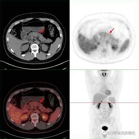 2023 2 单纯肾癌吗？抽丝剥茧式看pet Ct影像诊断及鉴别诊断最后结论vhl综合征（林岛综合征）全文 知乎