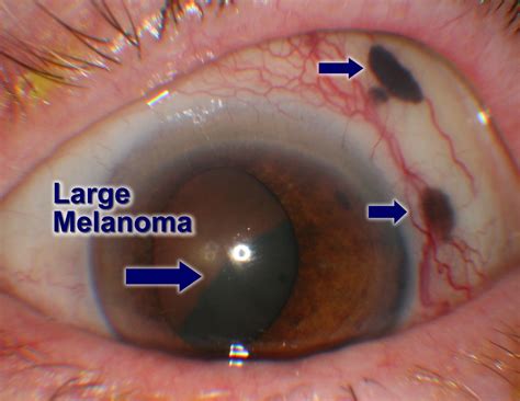 Ocular Melanoma Pictures 27 Photos And Images