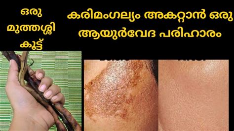 Ayurvedic Treatment To Cure Melasma കരിമംഗല്യം കറുത്ത പാട് മാറ്റാന്‍ ഒരു ആയുര്‍വേദ കൂട്ട്