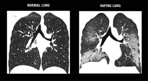 How To Reverse Smoking Lung Damage With Raw Organic Honey – Latin Honey ...