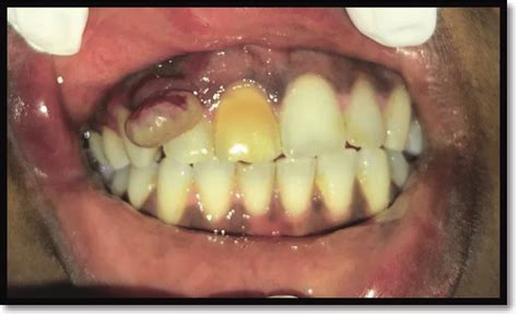 A Case Of Pyogenic Granuloma In Maxillary Right Lateral Incisor Region