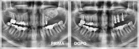 Rialzo Seno Mascellare Monza E Brianza Studio Dentistico Rizzacasa