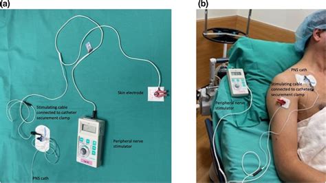 Peripheral Nerve Stimulation Through A Dry Peripheral Nerve Catheter