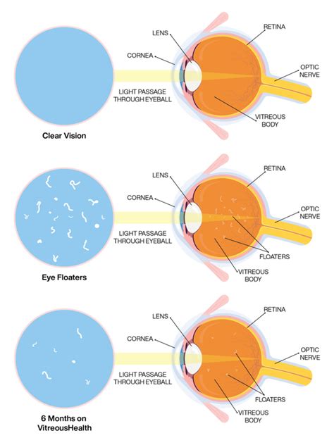 GET RID OF FLOATERS! - PALMER EYECARE CENTER