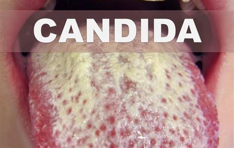 Candidiasis Causas Sintomas Y Tratamientos Con Remedios Caseros Images And Photos Finder