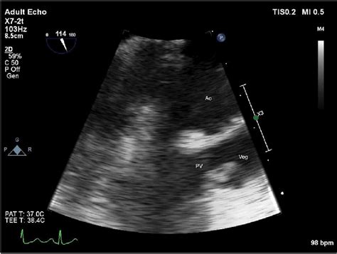 Vegetation On The Pulmonary Homograft On The Transoesophageal Download Scientific Diagram