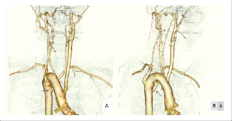 Ct Angiography Of The Aorta Reveals An Aberrant Left Subclavian Artery