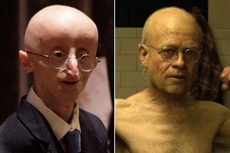 Real Life Benjamin Button Daily Star