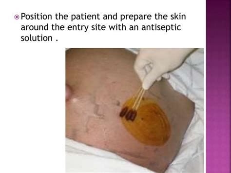 Abdominal Paracentesis