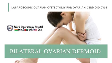 Bilateral Ovarian Dermoid Dermoid Cyst Youtube