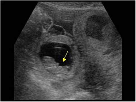 Gynaecology | 3.2 Adnexa : Case 3.2.5 Ectopic pregnancy | Ultrasound Cases