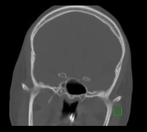 Bilateral Temporomandibular Joint Dislocation Image Radiopaedia Org