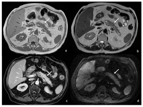 Tomography Free Full Text Stockypacked Pancreas A Case Of Focal Drug Induced Acute