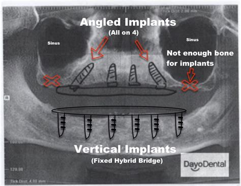 Denture Implants vs Fixed Bridge - Teeth Replacement Options - False teeth