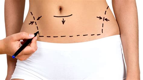 Cirugía del Abdomen Abdominoplastia DR FRANCISCO PRECIADO