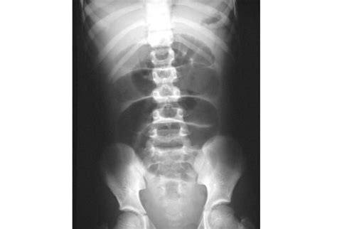 Radiography, Abdominal