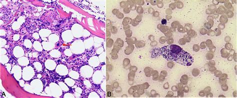 Figure 2 From A Case Report Of Pregnancy Complicated With Primary