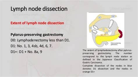 Management Of Metastatic Lymph Nodes In Gastric Cancer