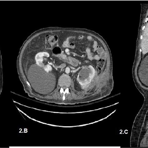 Ct Abdomen And Pelvis Sagittal View With Iv Contrast Showed Free